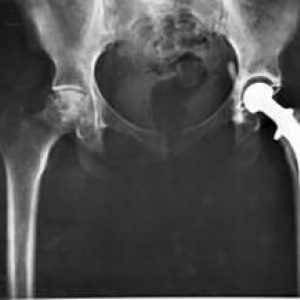 Când este necesară înlocuirea articulațiilor șoldului și ce consecințe poate avea această operație?
