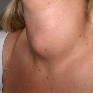 Guiderul coloidal al glandei tiroide - ce este? Cum să tratezi un glomeraj coloidal al glandei…