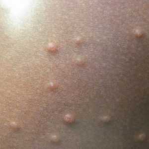 Moluscul contagios la un copil, tratamentul pielii