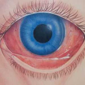 Proteine ​​de ochi roșii: cauze, efecte și metode de tratament. De ce sunt ochii roșii în vârstă…