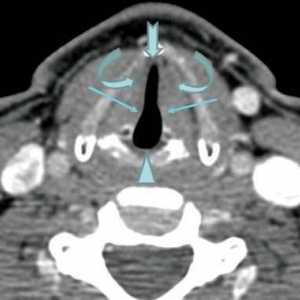 CT a laringelui: preturi, recenzii. Ce va arăta CT a gâtului și a laringelui?