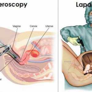 Laparoscopie și histeroscopie: indicații, recenzii, ceea ce este mai bine