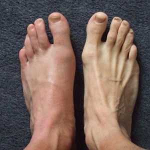 Tratamentul gutei pe picioare: principii de bază