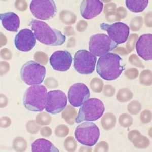 Leucemia: ce este aceasta și există o șansă pentru mântuire?