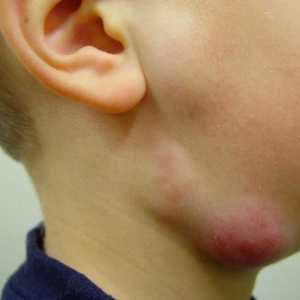 Limfadenita la copii: cauze, simptome și tratament