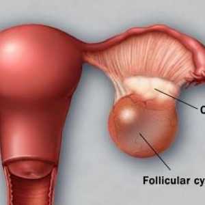Chist ovarian îngropat: simptome, metode de tratament, intervenții chirurgicale, consecințe