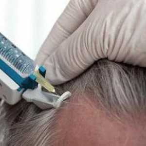 Mezoterapia scalpului: recenzii