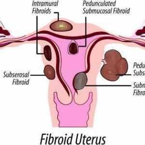 Myomii uterului: dimensiunile operației. Fibrele uterine: metode moderne de tratament