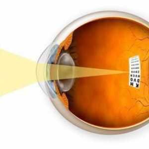 Micopia ochiului: simptome, cauze, diagnostic și tratament