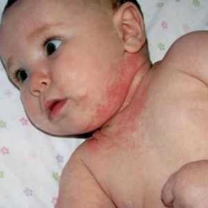 Dermatita umedă la copii: fotografie și tratament