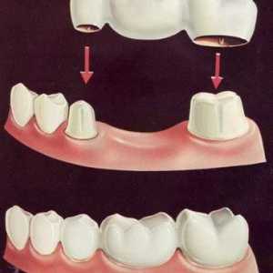 Poduri: argumente pro și contra. Recomandări dentare și feedback pacient