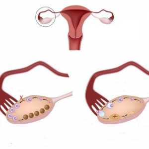 Ovare multifolliculară - ce este? Cauzele obișnuite ale diagnosticului și constatările greșite…