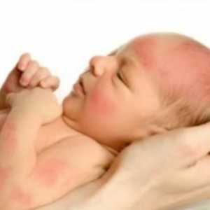 Cele mai frecvente boli ale pielii la un copil