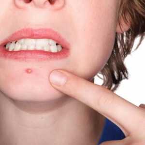 Remedii populare pentru acnee și acnee pe față și medicamente