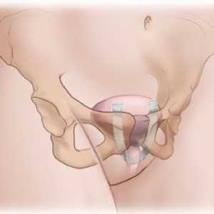 Incontinența urinei la tuse: cauze și metode de tratament