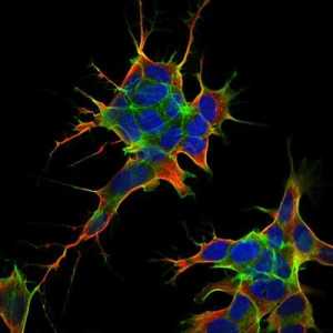 Neuroblastomul - ce este? Simptomele și tratamentul bolii