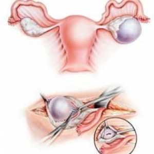 Obstrucția trompelor uterine: cum să rămâneți gravidă, cum să vă vindecați
