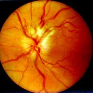 Nevrită optică: cauze, simptome, diagnostice și trăsături de tratament