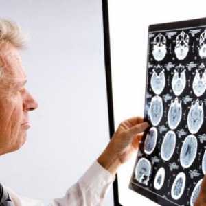 Neurologie: simptome cerebrale de leziuni ale creierului
