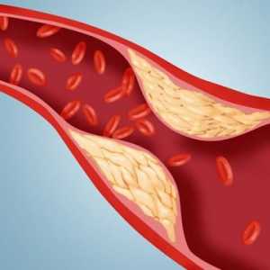 Norma colesterolului din sângele oamenilor. Indicatori ai colesterolului din sânge