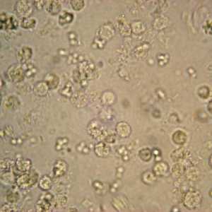 Norma leucocitelor în urină a copiilor. Leucocitele din urina unui copil: norma, motivele creșterii