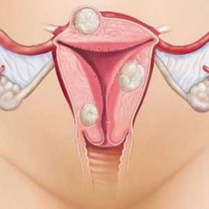 Durere foarte severă cu menstruație: cauze, tratament