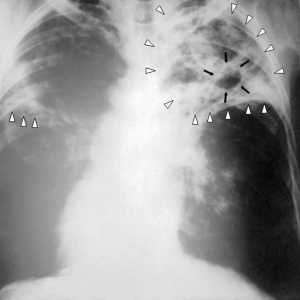 Perioada de incubație a tuberculozei este periculoasă?