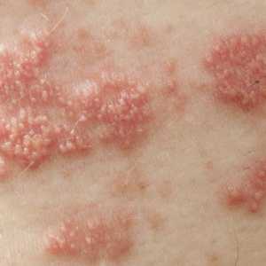 Herpes zoster: tratament, simptome și prevenire
