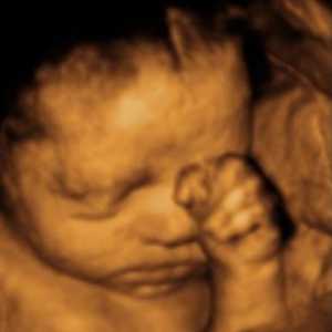 Determinarea sexului copilului prin ultrasunete, în măsura în care este corect