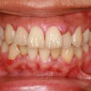 Guma sa umflat, dar dintele nu durează - ce să facă sau să facă? Cauze de umflare a gingiilor și…