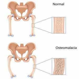 Osteomalacia: ce este, cauzele, simptomele, diagnosticul și trăsăturile de tratament