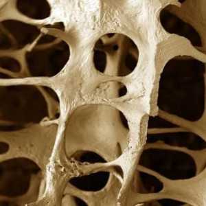 Osteopenie - ce este și ce metode de tratament