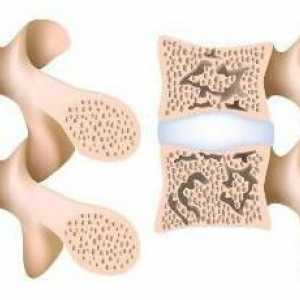 Osteoporoza coloanei vertebrale: simptome și tratament cu medicamente populare