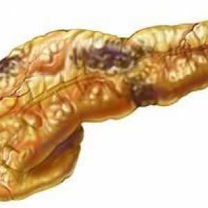 Necroza acută a pancreasului. Simptome, tratament