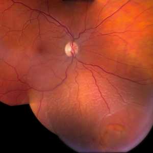 Detașarea retinei: cauze, simptome, tratament, intervenții chirurgicale