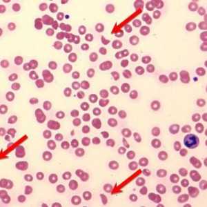 Hemoliza hematologică a sângelui: cauze, simptome și metode de tratament