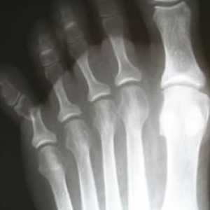 Fracturile degetelor de la picioare: cauze, simptome și tratamente