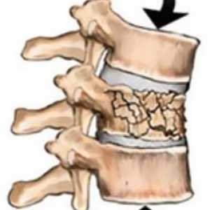 Fracturile coloanei vertebrale: tipuri și tratament