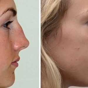Chirurgia plastica pe nas: fotografii, recenzii