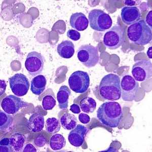 Celulele plasmatice reprezintă o componentă importantă în mediul leucocitelor