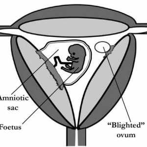 Fructless ou fără embrion. Poate un ovul fetal să nu aibă un embrion?