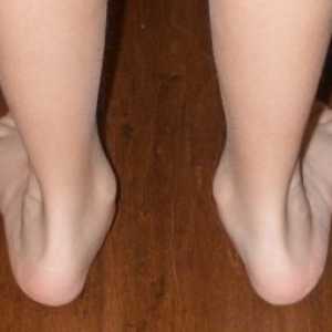 Din ce motiv se dezvoltă picioarele flat-valgus la copii și cum să le tratezi?