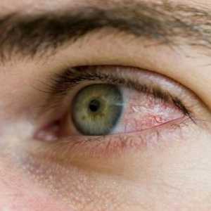 De ce sunt ochii roșii și cum se elimină disconfortul?