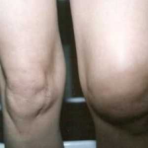 De ce este genunchiul umflat și dureros? Cauze și tratament