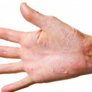 De ce este pielea pe mâinile tale și cum să te descurci cu ea?