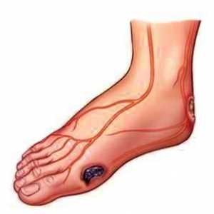 În detaliu despre ce și cum să tratezi ulcerul trofic pe picioare