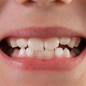 Mobilitatea dinților: grad, cauze, tratament