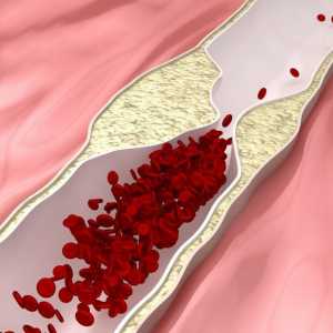 Indicații pentru utilizare `Indapamid` - hipertensiune arterială