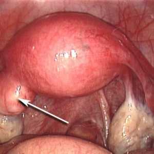 Endometrul polip: tratament fără intervenții chirurgicale și recenzii