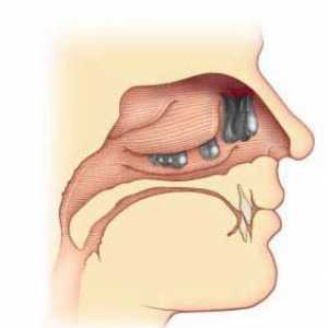Polipi în nas: tratament fără intervenție chirurgicală. Tratamentul polipului în nas cu remedii…